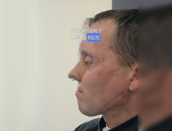 Помните мужчину, которому на руке вырастили нос? Хирург рассказал, как его дела Помните мужчину, которому на руке вырастили нос? Хирург рассказал, как его дела