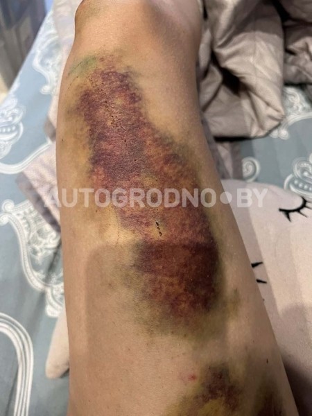 На опасной велодорожке девушка сломала три ребра и ключицу На опасной велодорожке девушка сломала три ребра и ключицу